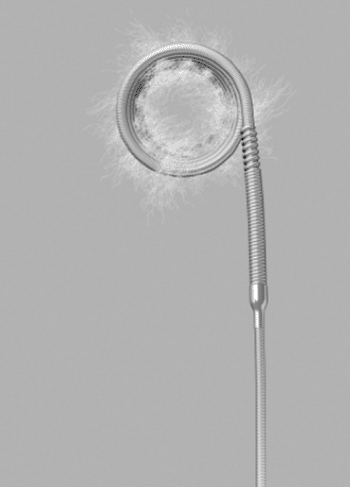 Image: The Retracta detachable embolization coil (Photo courtesy of Cook Medical).
